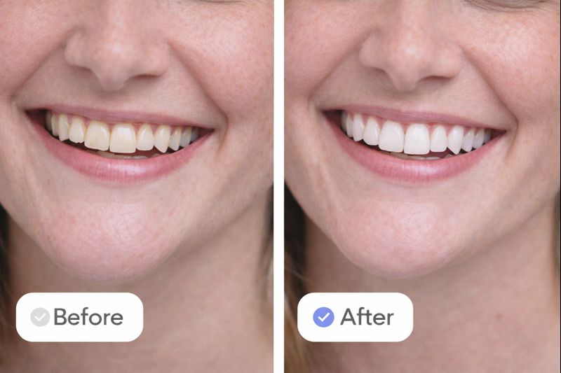 teeth whitening before after 3